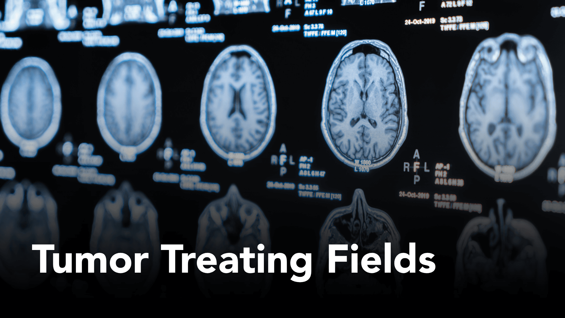 Bringing Tumor Treating Fields to Practice: Lessons From Three Cancer Programs